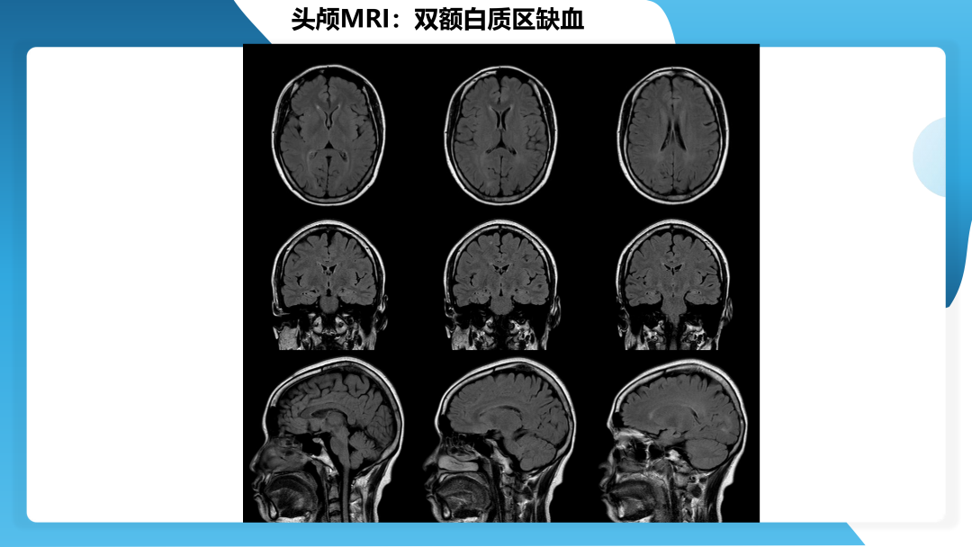 治疗抗 LGI1 抗体相关自身免疫性脑炎继发癫痫一例
