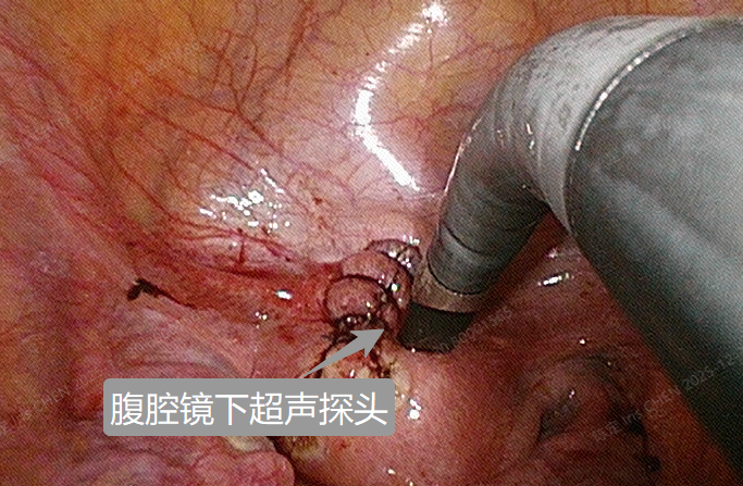 为手术刀装上「实时导航」：当术中超声成为妇科医生的「第二双眼」