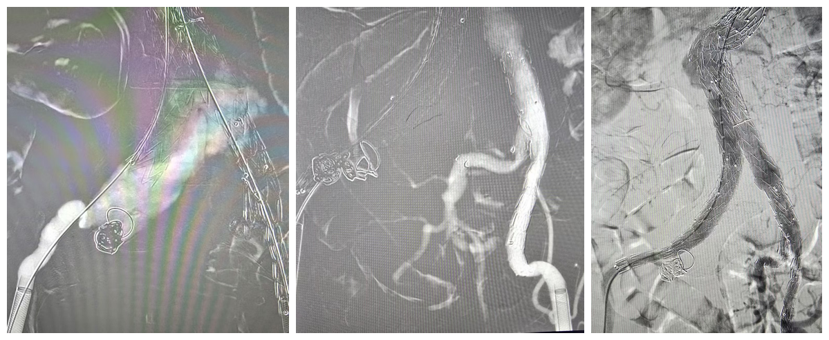 全市首例「腹主动脉——双髂动脉腔内隔绝术」在镇江瑞康医院成功实施