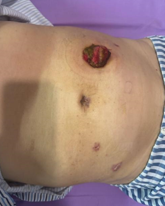 3 个「钥匙孔」完成肠切除，苏州明基胃肠外科精准微创技术