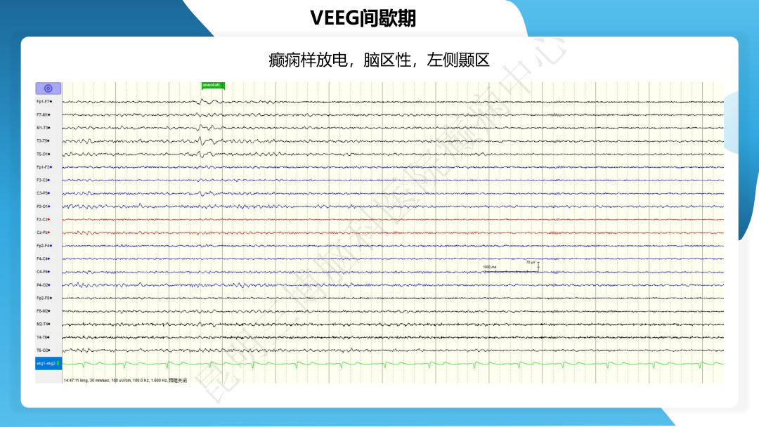 治疗抗 LGI1 抗体相关自身免疫性脑炎继发癫痫一例