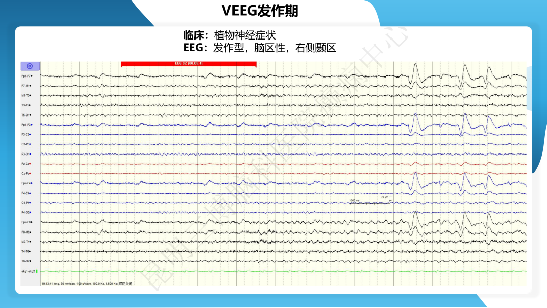 治疗抗 LGI1 抗体相关自身免疫性脑炎继发癫痫一例