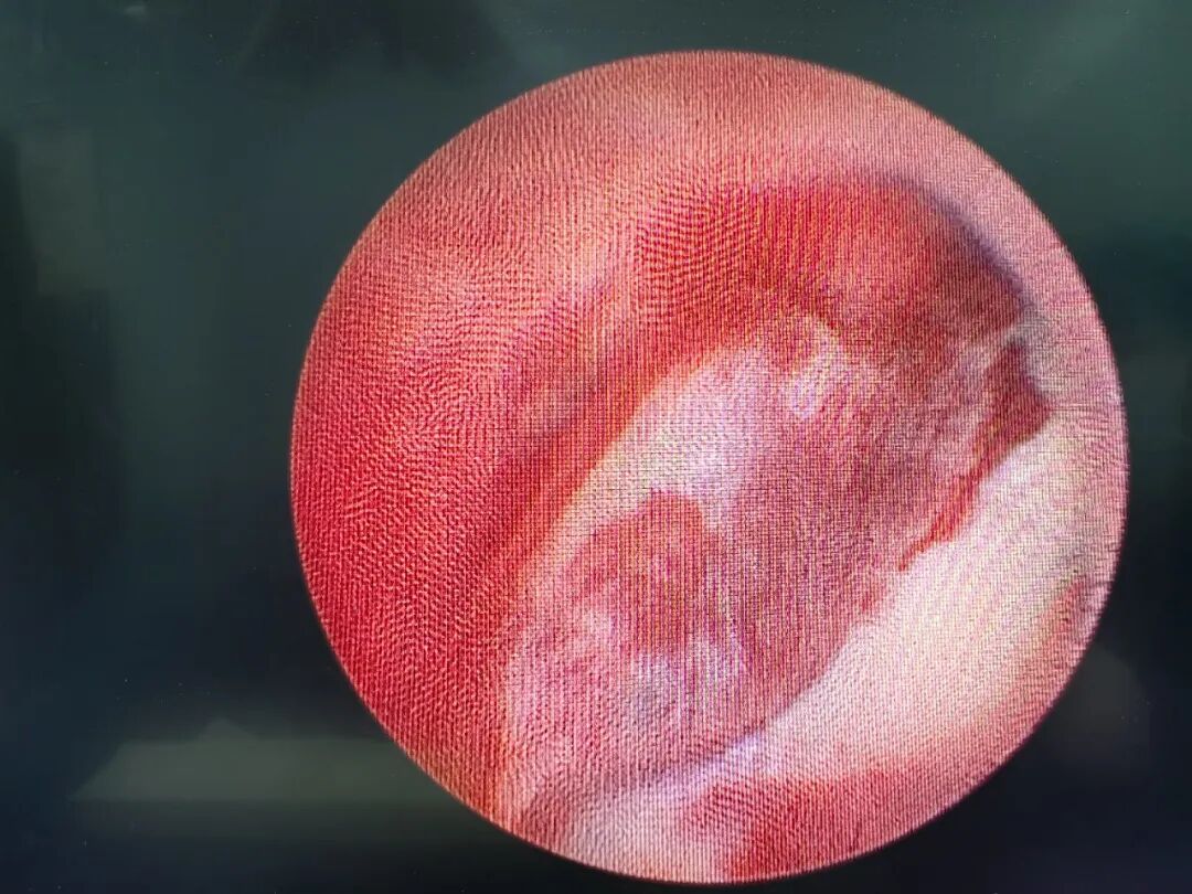 尿血还带血块！62 岁阿姨吓坏了