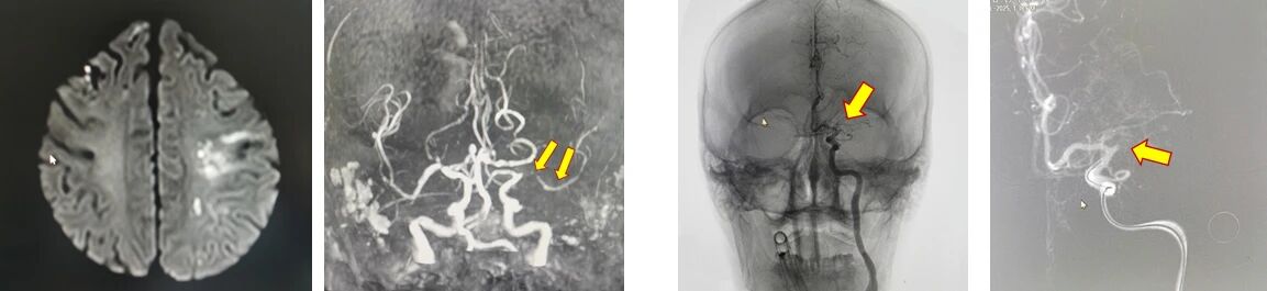 87 岁老人突发脑梗，上海天佑医院多学科联合「黄金时间」内成功取栓