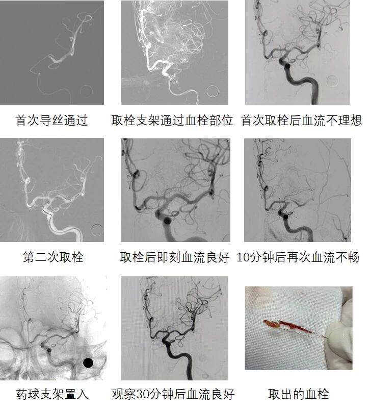 87 岁老人突发脑梗，上海天佑医院多学科联合「黄金时间」内成功取栓
