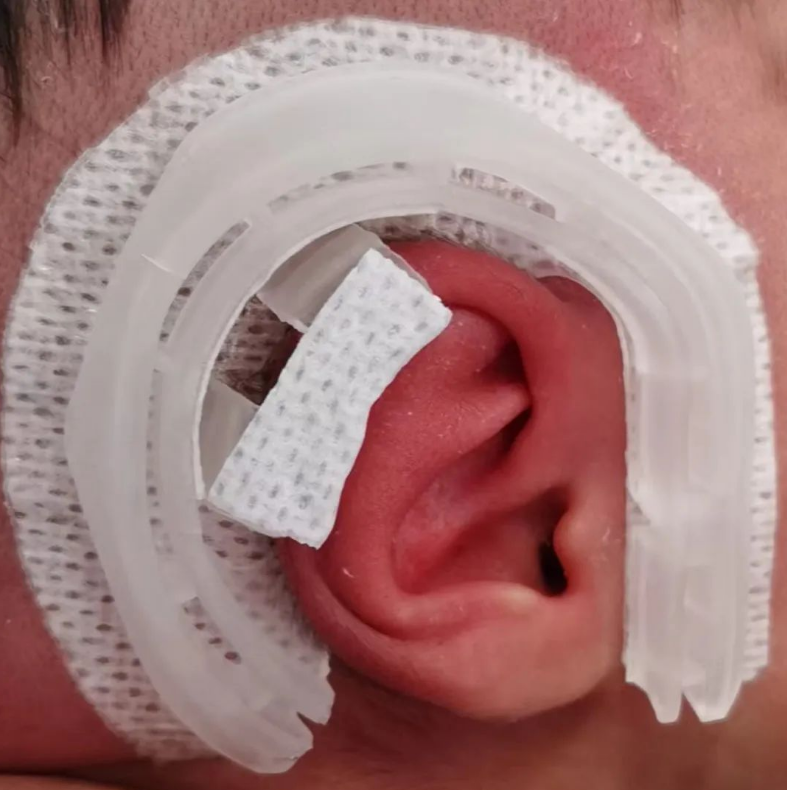 别被 「可爱」误导！大耳朵图图的招风耳是耳廓畸形，专家呼吁：「耳廓矫正应抓住黄金治疗期！」