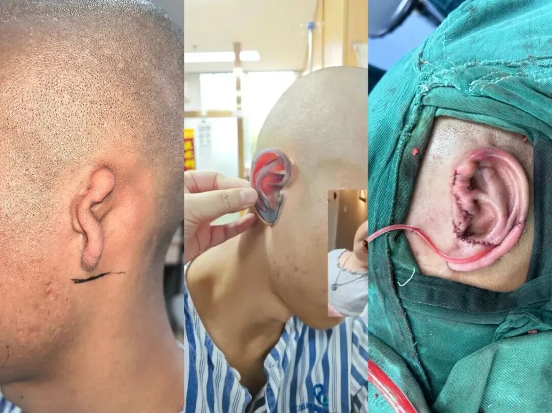 别被 「可爱」误导！大耳朵图图的招风耳是耳廓畸形，专家呼吁：「耳廓矫正应抓住黄金治疗期！」