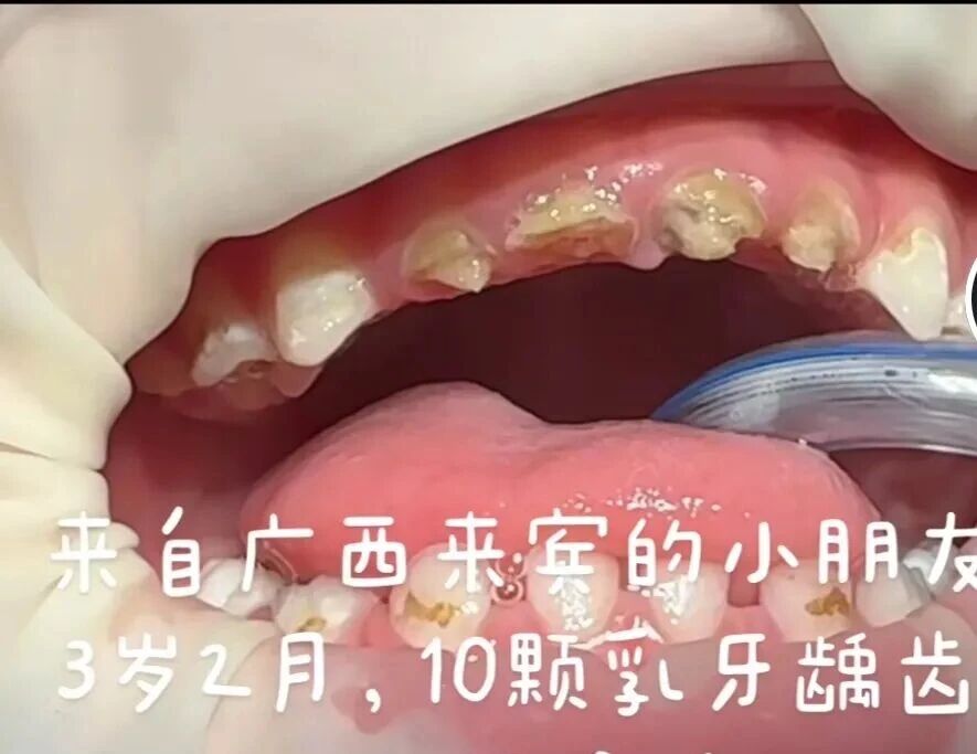 医治 10 颗蛀牙,还给 3 岁宝宝健康口腔