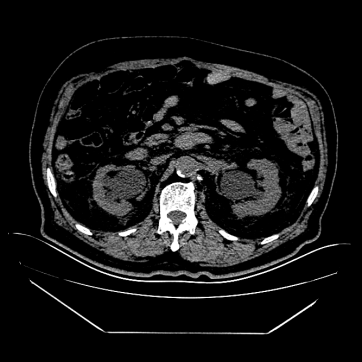 「尿不净」竟伤肾!两位老人险遭肾衰,这个信号别再忽视