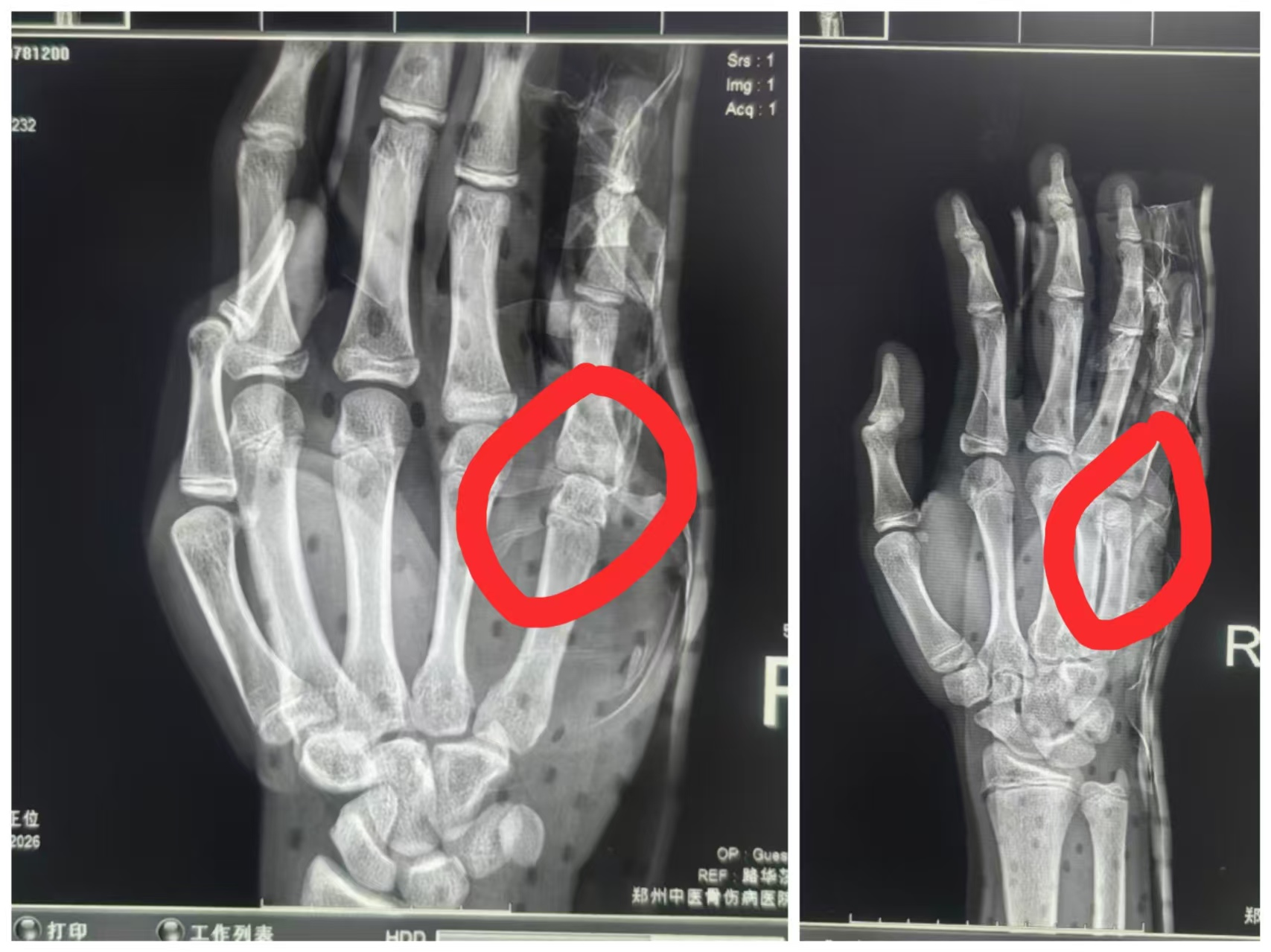 两分钟！摸一摸，掰一掰，孩子错位的手骨瞬间「归位」