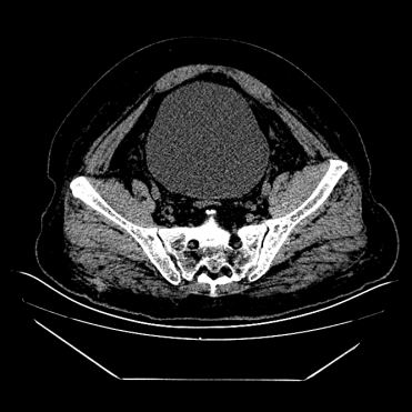 「尿不净」竟伤肾!两位老人险遭肾衰,这个信号别再忽视