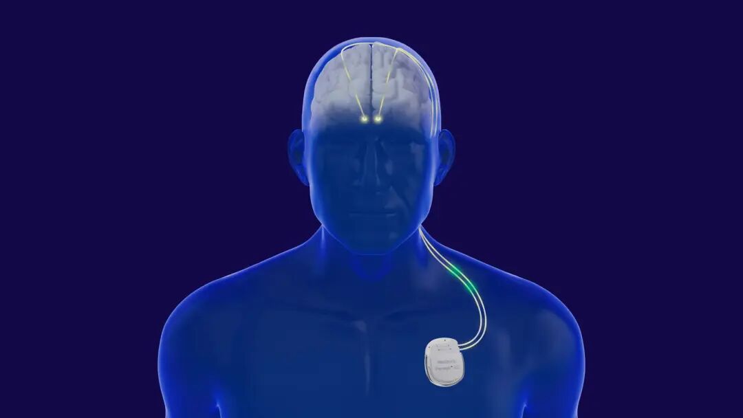 脑机接口技术已经临床应用于治疗帕金森病等神经功能疾病