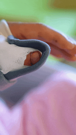 不敢看!4 根手指卷入压面机,拇指仅连一层皮…