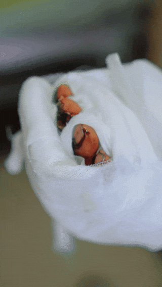 不敢看!4 根手指卷入压面机,拇指仅连一层皮…