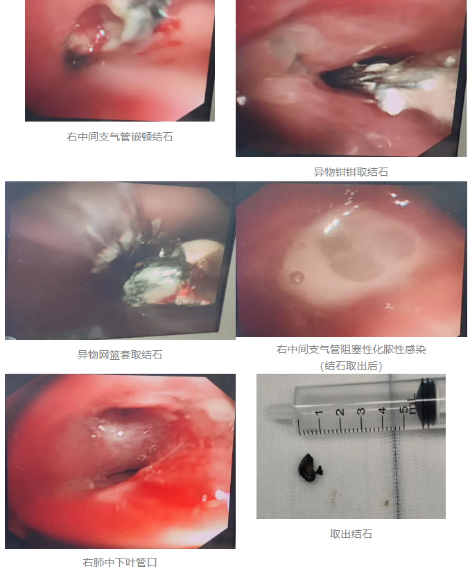 病例会说话 | 七旬老人免遭切肺之痛,只因医生坚持一次「镜下冒险」