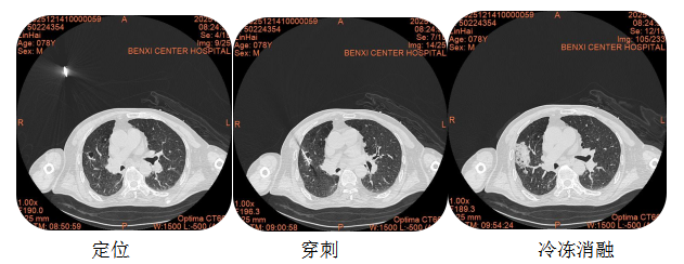 从「开胸剖肺」到「针尖除瘤」——本溪市中心医院心胸外科成功开展市首例 CT 引导下肺部肿瘤冷冻消融术