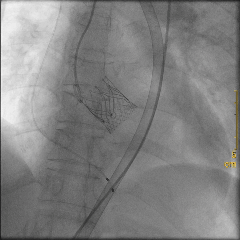 不开胸换「心门」！绵阳市中心医院心血管内科完成川西北地区首两例微创瓣膜置换
