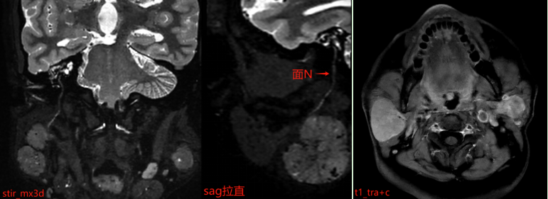 典型病例 | 认识腮腺占位性病变：医学影像如何助力精准诊疗