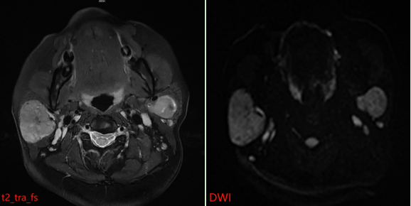 典型病例 | 认识腮腺占位性病变：医学影像如何助力精准诊疗