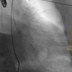 不开胸换「心门」！绵阳市中心医院心血管内科完成川西北地区首两例微创瓣膜置换
