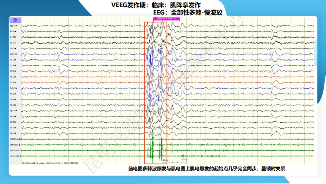 《「痫停」信步》癫痫治疗病例荟萃第四十七期---青少年肌阵挛癫痫病例分享 1 例