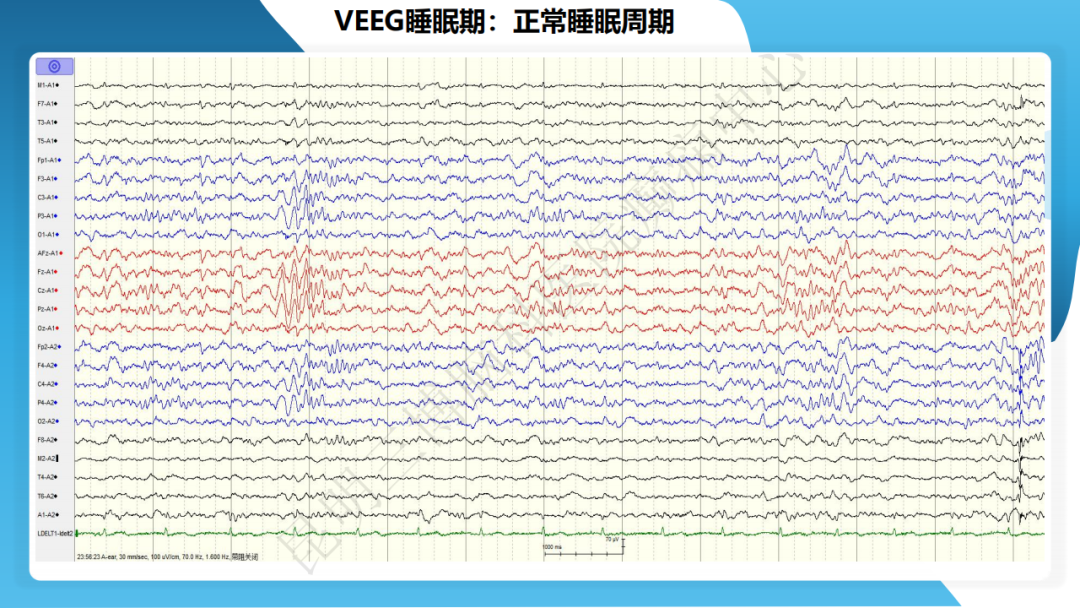 《「痫停」信步》癫痫治疗病例荟萃第四十七期---青少年肌阵挛癫痫病例分享 1 例