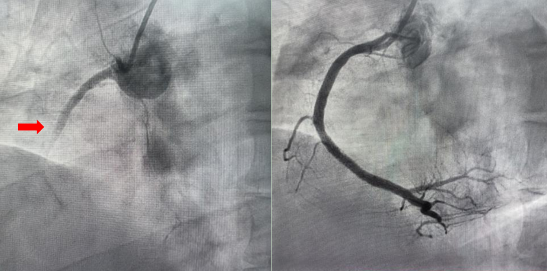 24 岁小伙突发心梗「劫后重生」！年轻人别大意，这些习惯你中了几条？