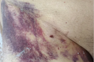 术后并发假性动脉瘤？燕达医院血管外科微创封堵术给出规范化解决方案