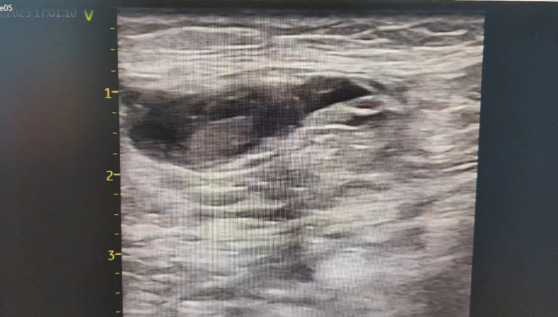 术后并发假性动脉瘤?燕达医院血管外科微创封堵术给出规范化解决方案