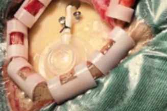 精准「弹药库」直击脑瘤——河科大二附院神经外科成功为 3 位患者植入 Ommaya 囊