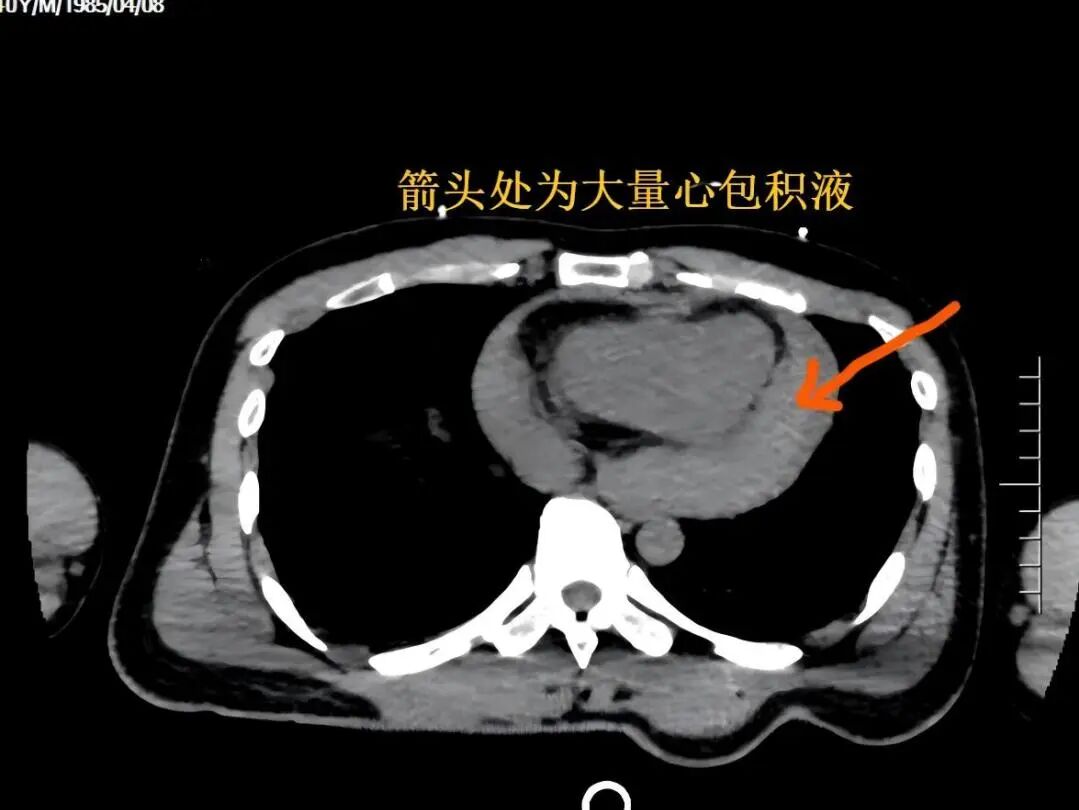 男子高处坠落命悬一线，前海人寿广州总医院心胸外科上演一场「生死营救」