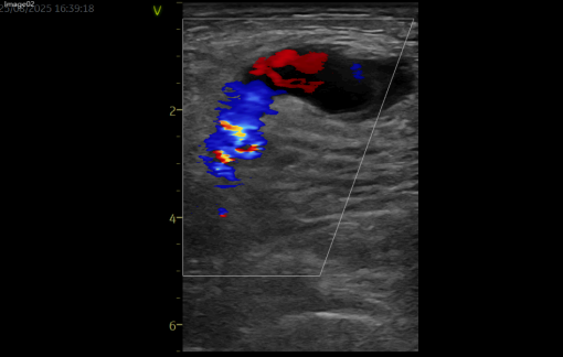 术后并发假性动脉瘤?燕达医院血管外科微创封堵术给出规范化解决方案