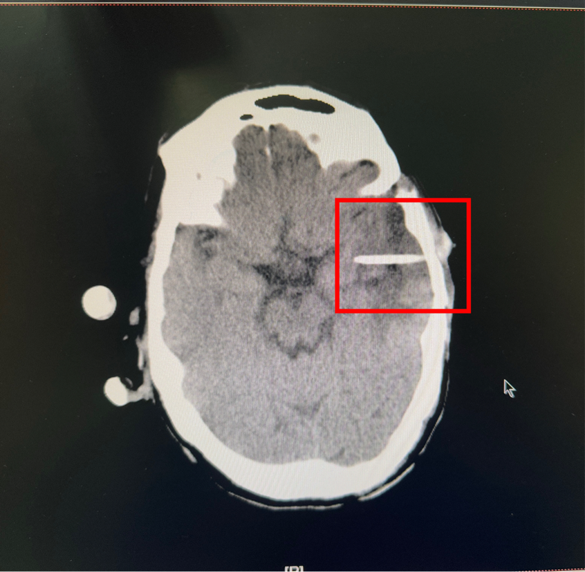精准「弹药库」直击脑瘤——河科大二附院神经外科成功为 3 位患者植入 Ommaya 囊