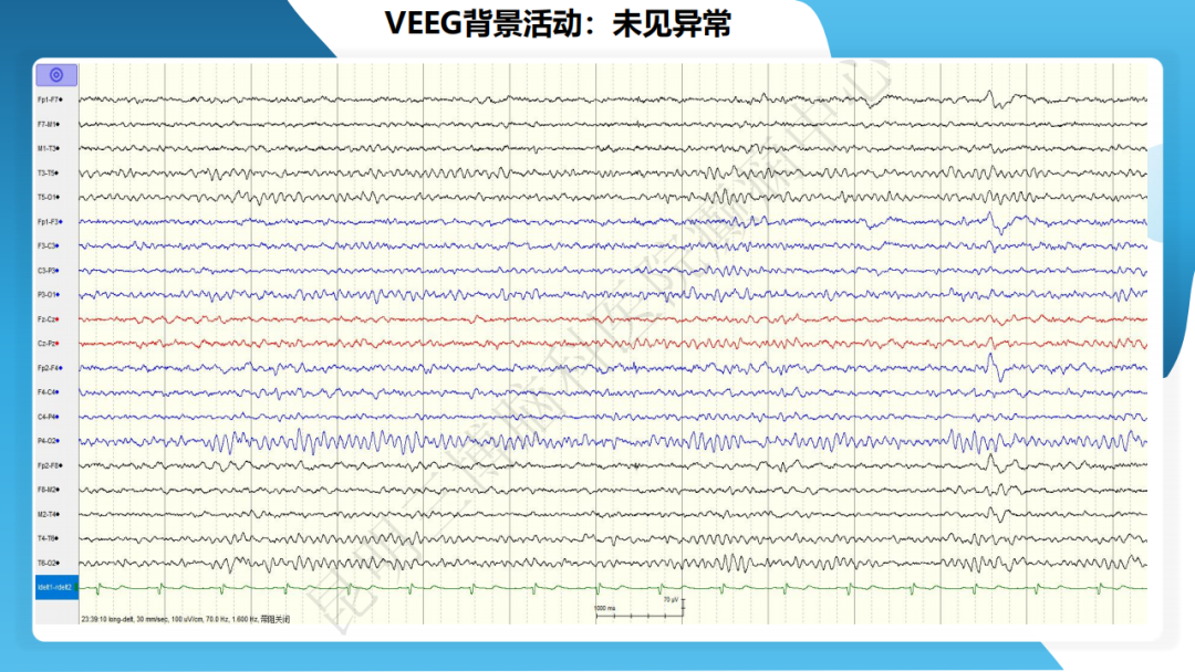 《「痫停」信步》癫痫治疗病例荟萃第四十七期---青少年肌阵挛癫痫病例分享 1 例