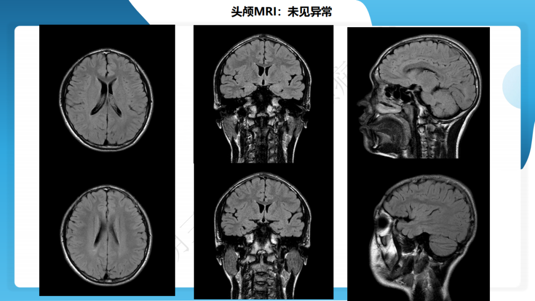 《「痫停」信步》癫痫治疗病例荟萃第四十七期---青少年肌阵挛癫痫病例分享 1 例