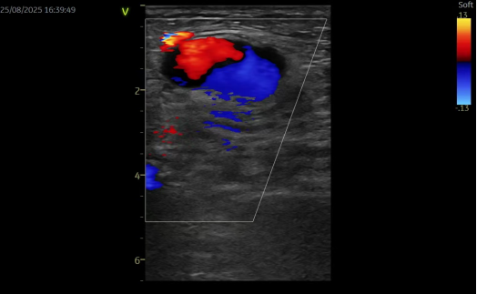术后并发假性动脉瘤?燕达医院血管外科微创封堵术给出规范化解决方案