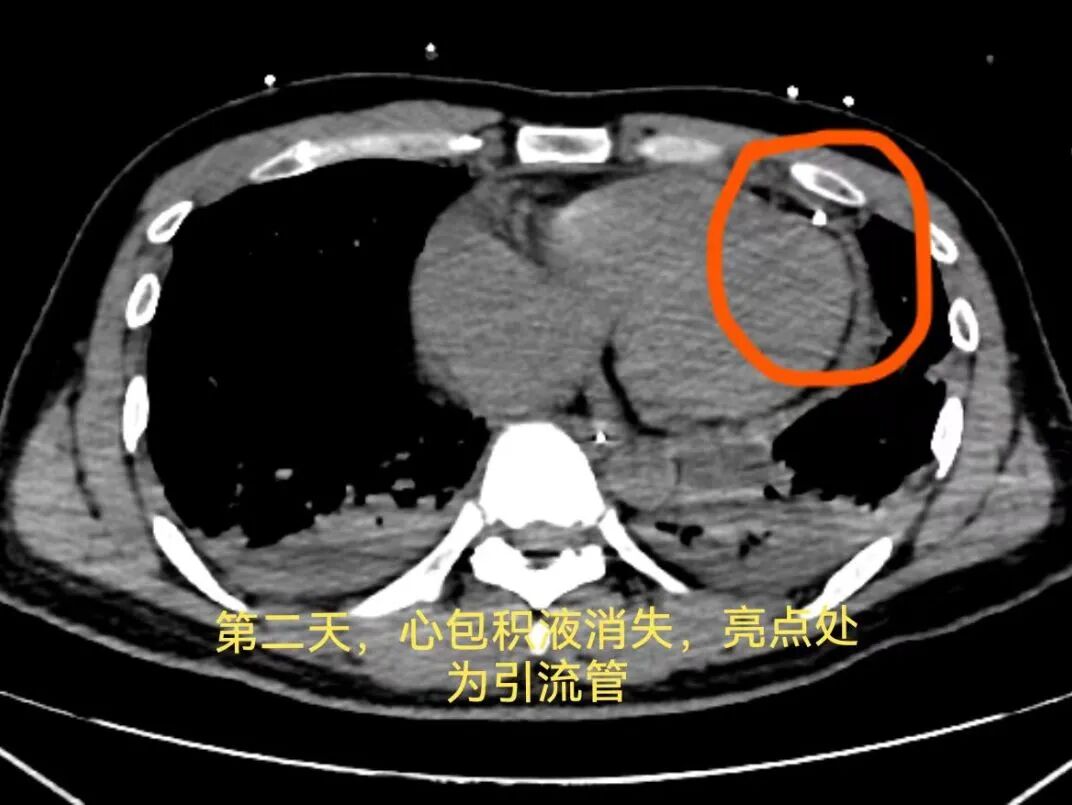 男子高处坠落命悬一线，前海人寿广州总医院心胸外科上演一场「生死营救」