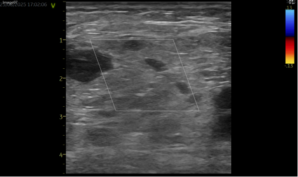 术后并发假性动脉瘤?燕达医院血管外科微创封堵术给出规范化解决方案
