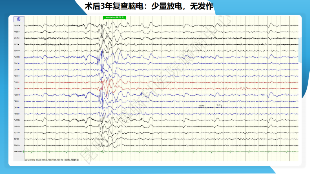 《「痫停」信步》癫痫治疗病例荟萃第四十七期---青少年肌阵挛癫痫病例分享 1 例