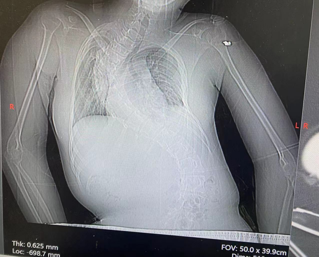 揪心！重症肌无力女孩遭遇肺炎突袭，儿科医护倾力护航渡险关