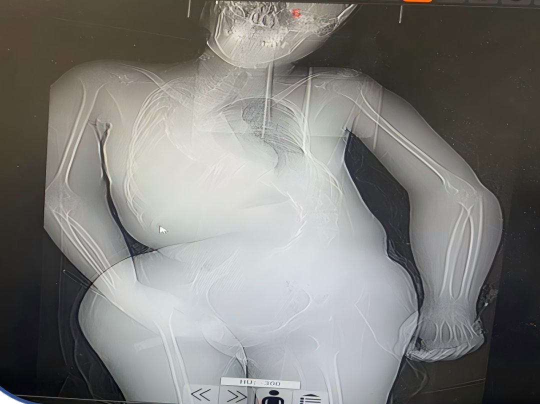 揪心！重症肌无力女孩遭遇肺炎突袭，儿科医护倾力护航渡险关