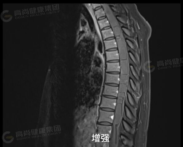 【高尚病例】室管膜瘤 1 例