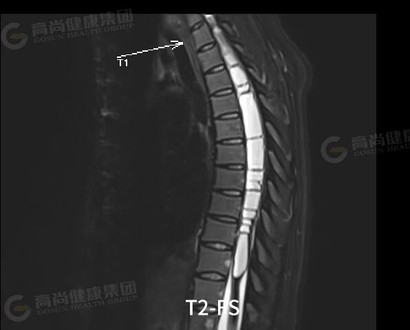 【高尚病例】室管膜瘤 1 例