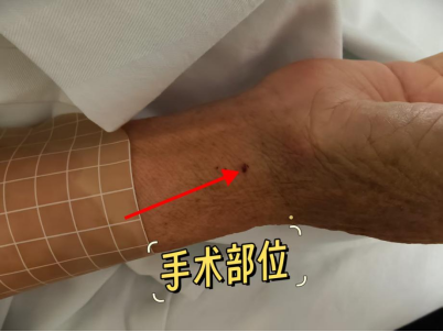 手腕处穿刺，大脑里「拆弹」