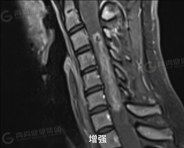 【高尚病例】室管膜瘤 1 例