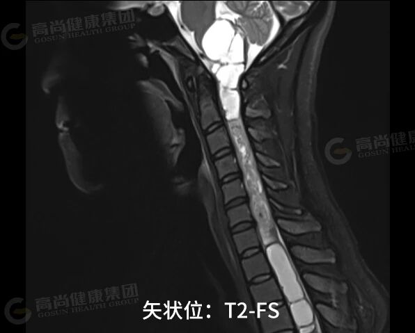 【高尚病例】室管膜瘤 1 例