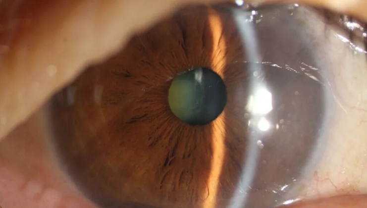 北京华厦民众眼科医院助民警母亲重获清晰视界