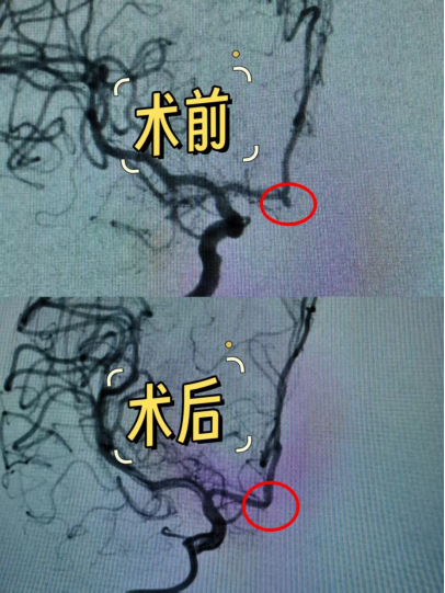 手腕处穿刺，大脑里「拆弹」