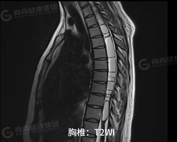 【高尚病例】室管膜瘤 1 例