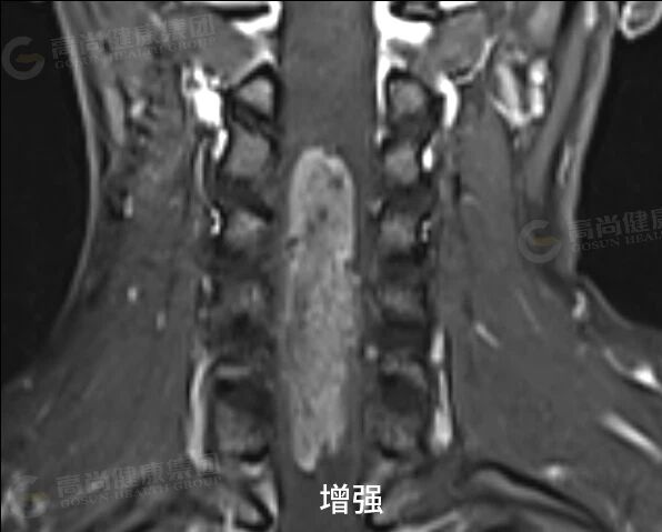 【高尚病例】室管膜瘤 1 例